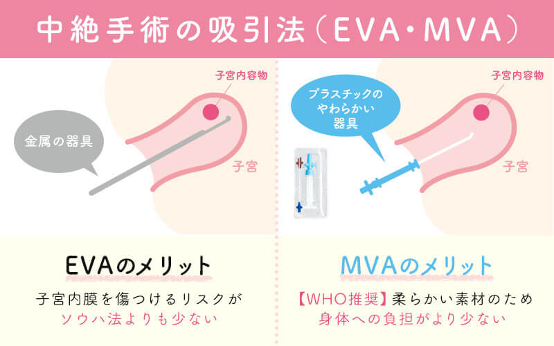 中絶手術の方法３種類（ソウハ法・吸引法EVA・吸引法MVA）