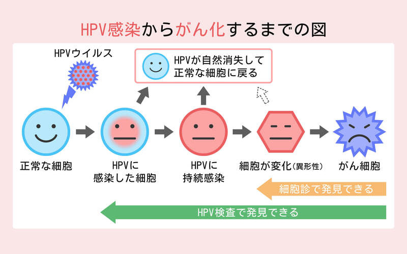 HPV感染からがん化するまでの図