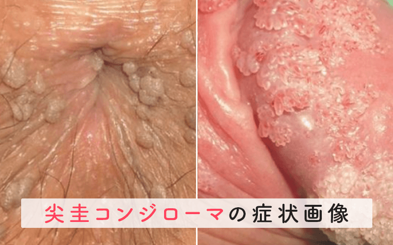 尖圭コンジローマによる症状の画像