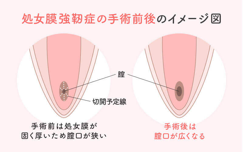 処女膜強靭症の手術前後のイメージ図