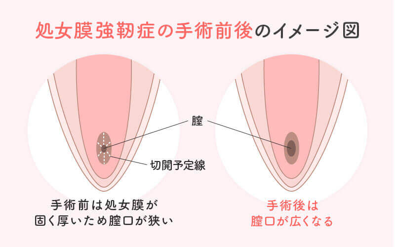 Japan hymen 