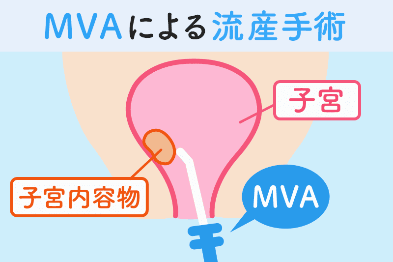 MVAによる流産手術のイメージ