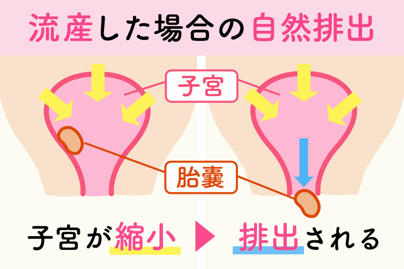 流産した場合の自然排出（子宮が収縮⇒排出される）