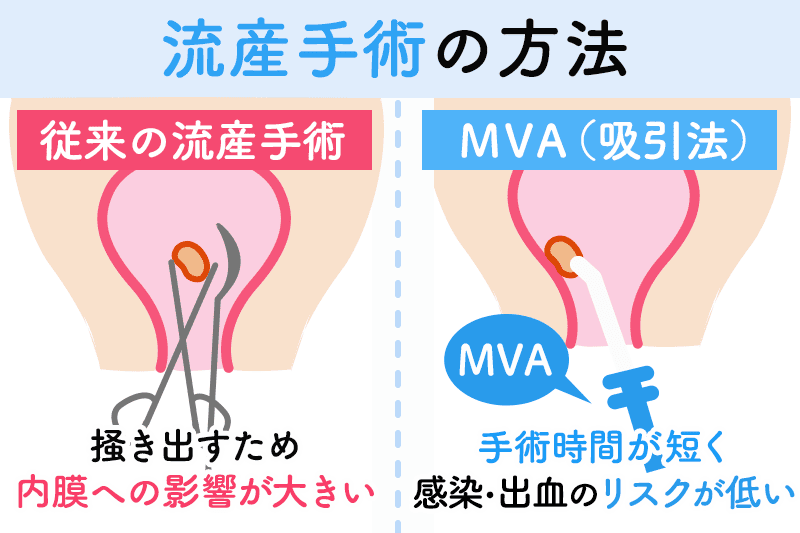 流産手術の方法（従来の方法・MVA吸引法）の比較イメージ