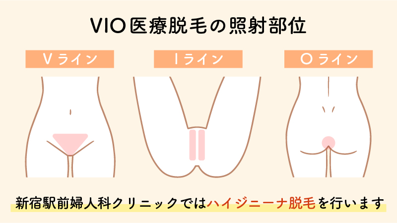 VIO医療脱毛の照射部位