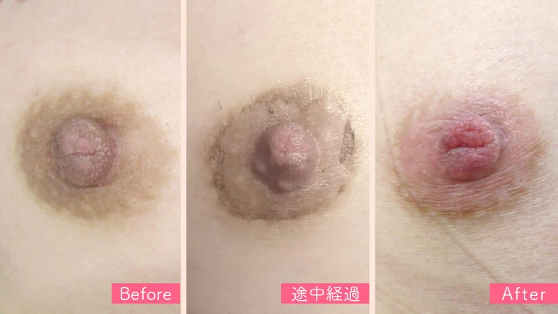 ローマピンク バストトップ（乳輪）の症例写真２