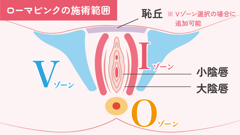 ローマピンクのVIO施術部位